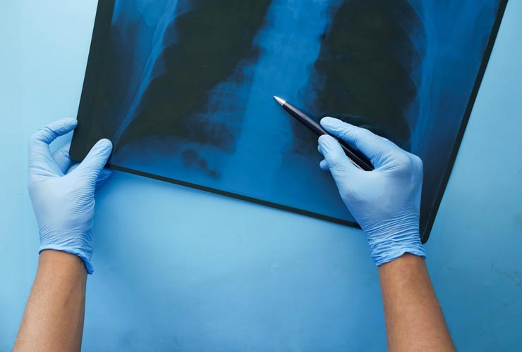 Problemi-polmoni-Foto-di-Towfiqu-barbhuiya-da-Pexels-Alganews